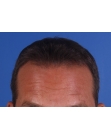 After Hair Transplant &nbsp;2 Sessions (Areas)